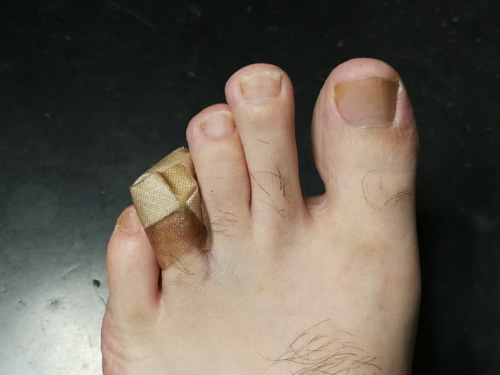 足の指を負傷